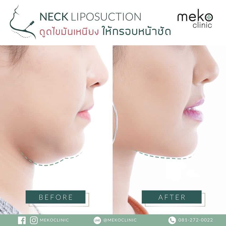 ดูดไขมันเหนียงให้กรอบหน้าชัด-1