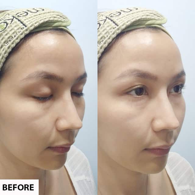 ตาสองชั้น+เสริมคาง หมอศุ เมโกะ คลินิก คุณพีค