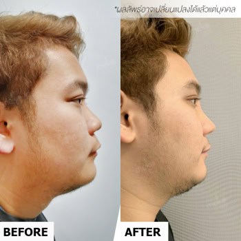 เสริมจมูก หมอชัย เมโกะ คลินิก คุณพัฒน์