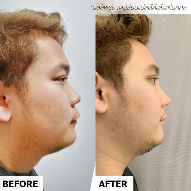 เสริมจมูก หมอชัย เมโกะ คลินิก คุณพัฒน์