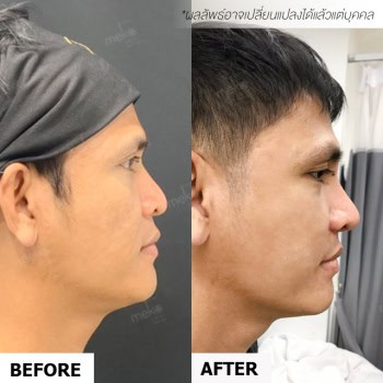 เสริมจมูก หมอชัย เมโกะ คลินิก คุณศศิ