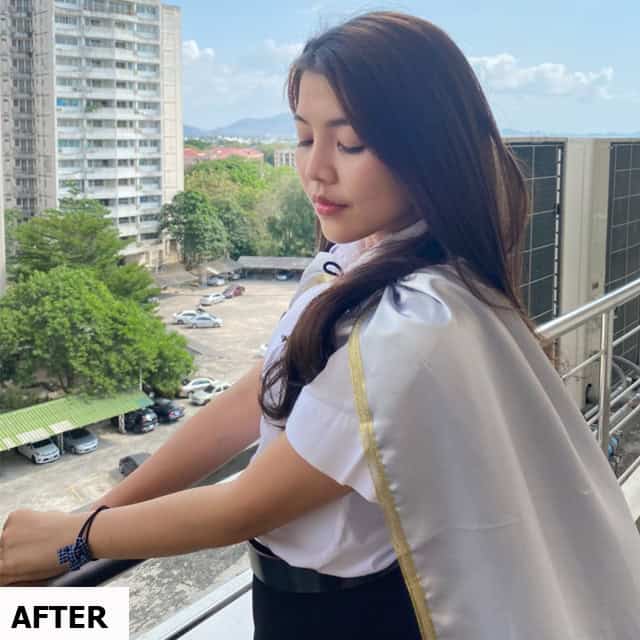 เสริมจมูก หมอชัย เมโกะ คลินิก คุณสุพัตรา