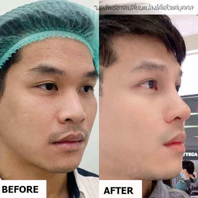 เสริมจมูก หมอมนัส เมโกะ คลินิก คุณกร