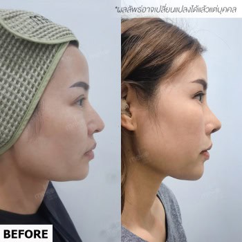 แก้จมูก open หมออา เมโกะ คลินิก คุณกร