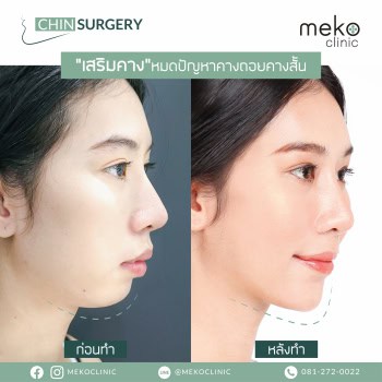 รีวิวศัลยกรรมคางโดยนพ. ยงเกียรติ ธนะเจริญพาณิชย์