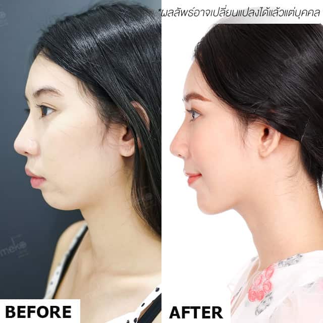 รีวิวศัลยกรรมคางโดยนพ. ยงเกียรติ ธนะเจริญพาณิชย์