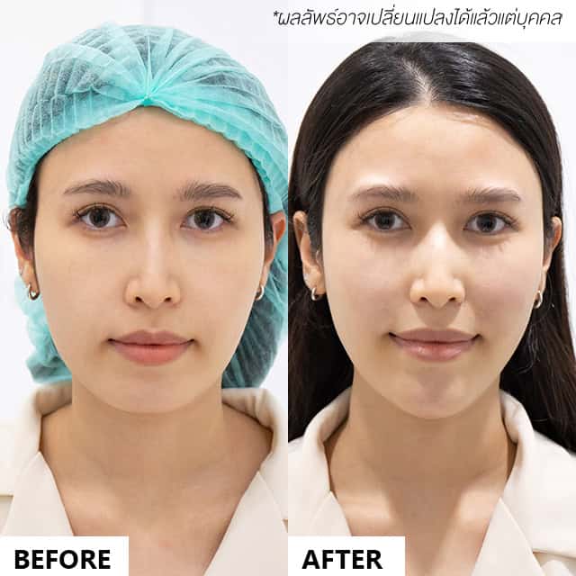 Filler (ฟิลเลอร์) Dr.Au mekoclinic ploy