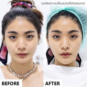 HIFU dr.fon mekoclinic so ซอโซ่ the face