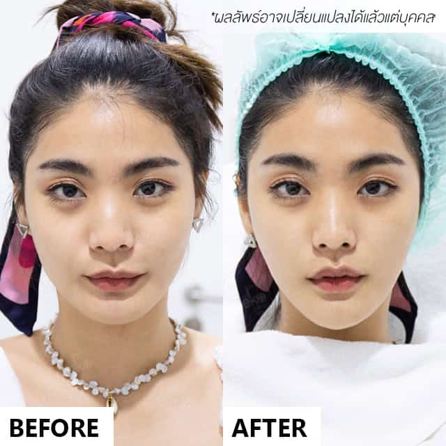 HIFU dr.fon mekoclinic so ซอโซ่ the face