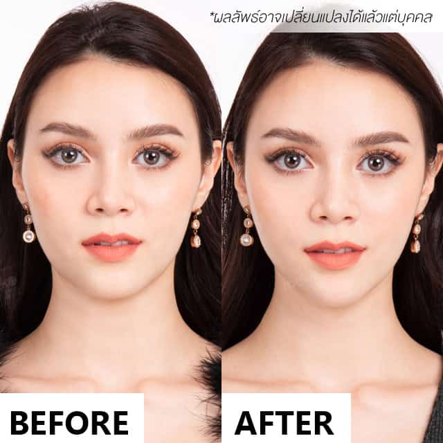 mesofat mekoclinic meme