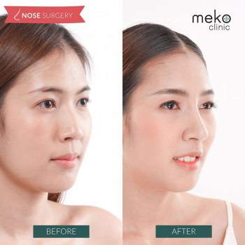 เสริมจมูก หมอมนัส เมโกะ คลินิก ส้ม