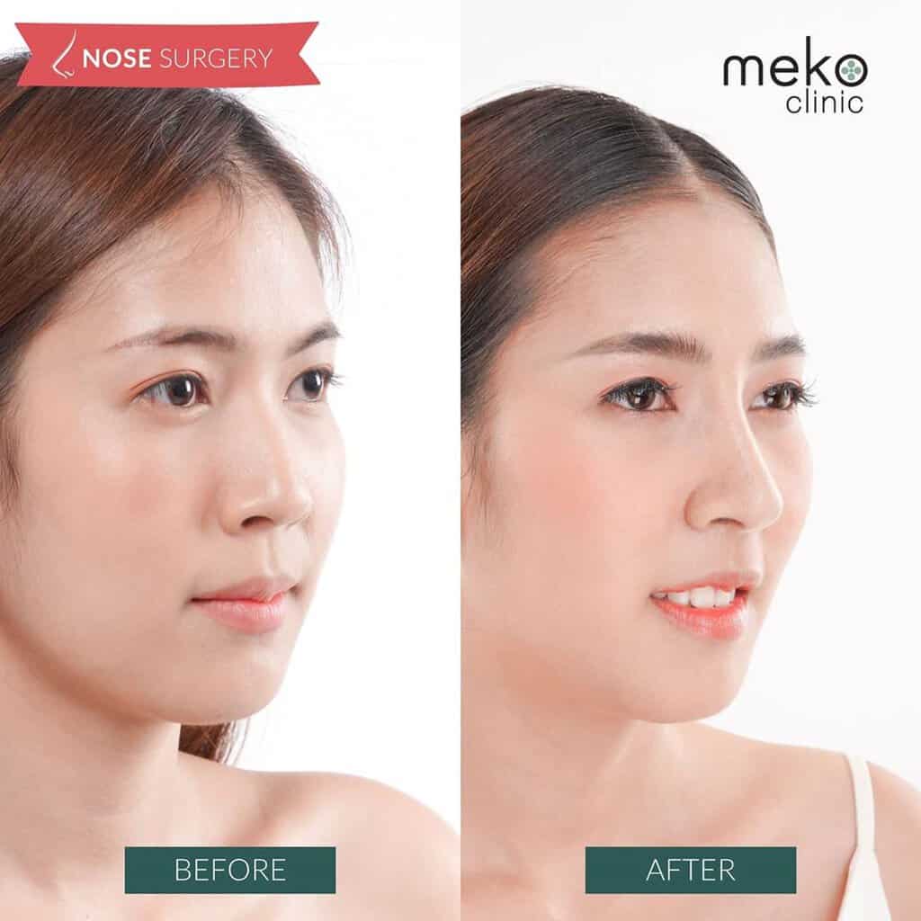 เสริมจมูก หมอมนัส เมโกะ คลินิก ส้ม