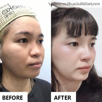 เสริมจมูก หมออา เมโกะ คลินิก คุณฟิล์ม