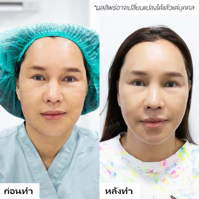 ulthera dr.fon mekoclinic som