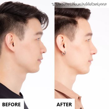 เสริมจมูก หมอมนัส เมโกะ คลินิก คุณโอม