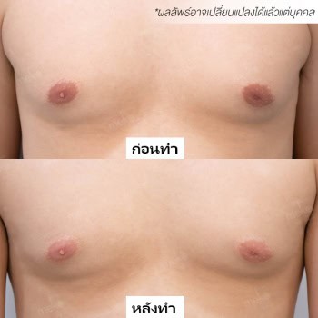 เลเซอร์ หมอแจน เมโกะ คลินิก คุณปั้น