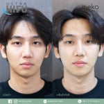 Hifu dr.jan mekoclinic