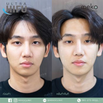 Hifu dr.jan mekoclinic