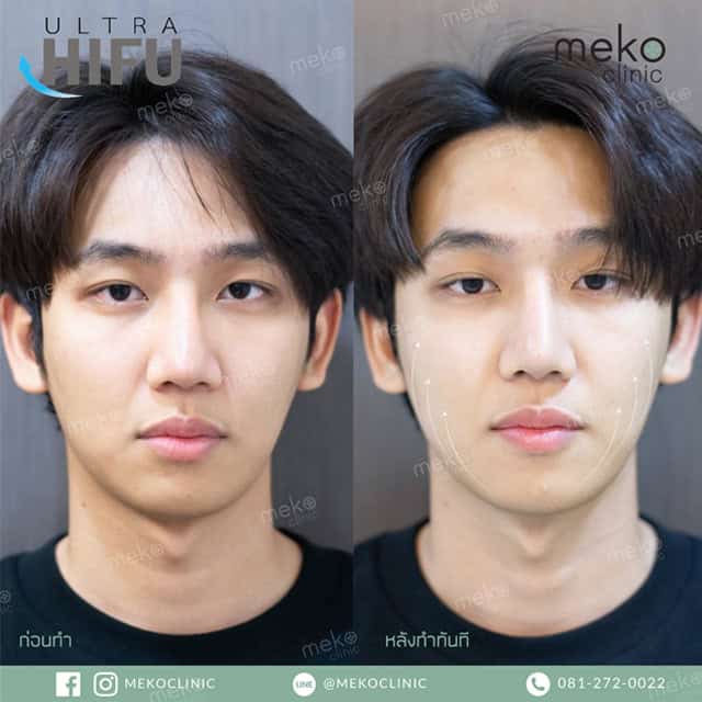 Hifu dr.jan mekoclinic