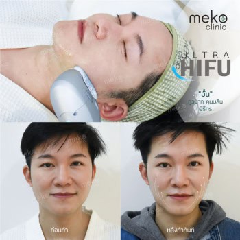 Hifu dr.fon mekoclinic คุณอั๋น ภูวนาท