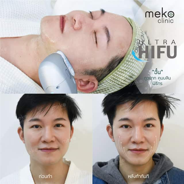 Hifu dr.fon mekoclinic คุณอั๋น ภูวนาท