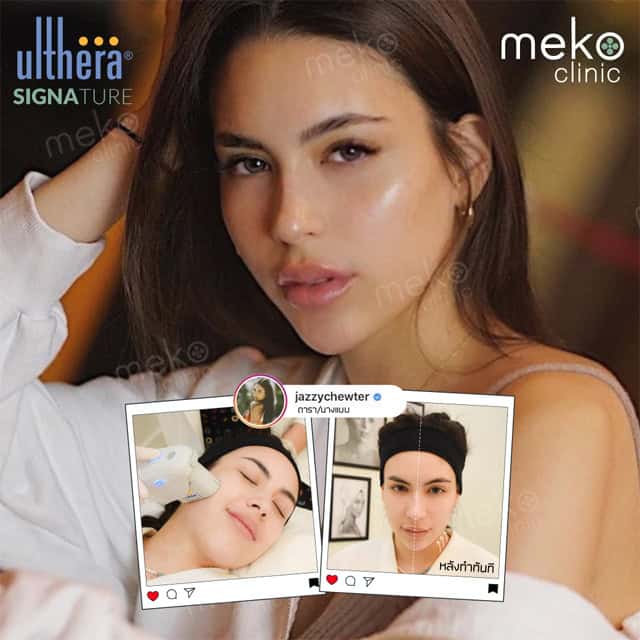 Ulthera mekoclinic เจสซี่