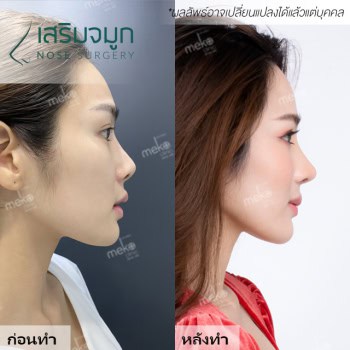 เสริมจมูก หมยง เมโกะคลินิก คุณวิว