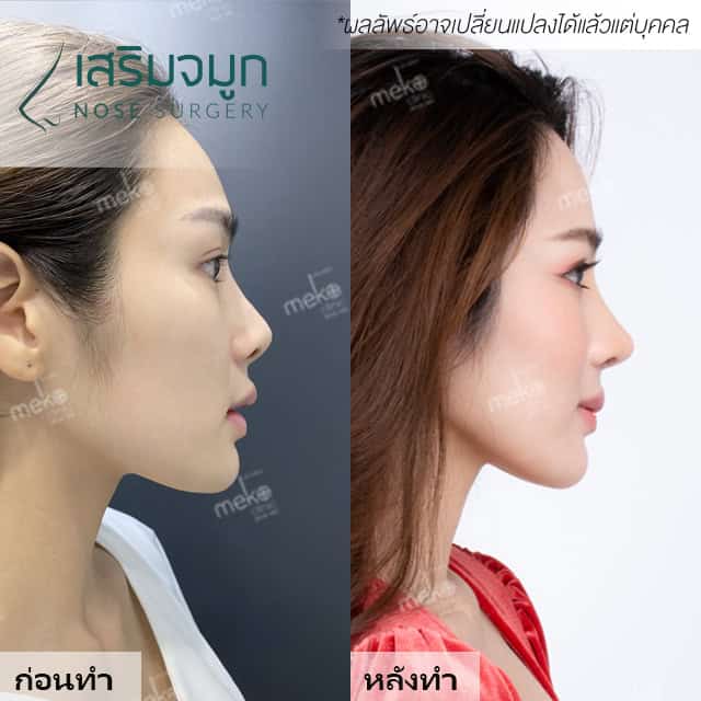 เสริมจมูก หมยง เมโกะคลินิก คุณวิว