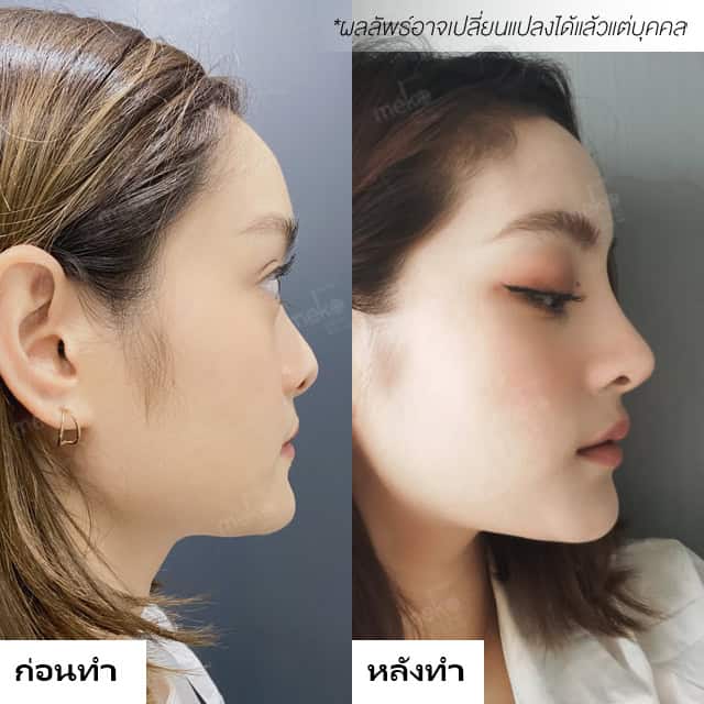 เสริมจมูก หมอแพร เมโกะคลินิก คุณอายตา