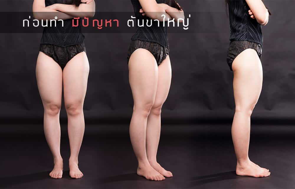 ดูดไขมันต้นขา-หมอยง-เมโกะคลินิก-5