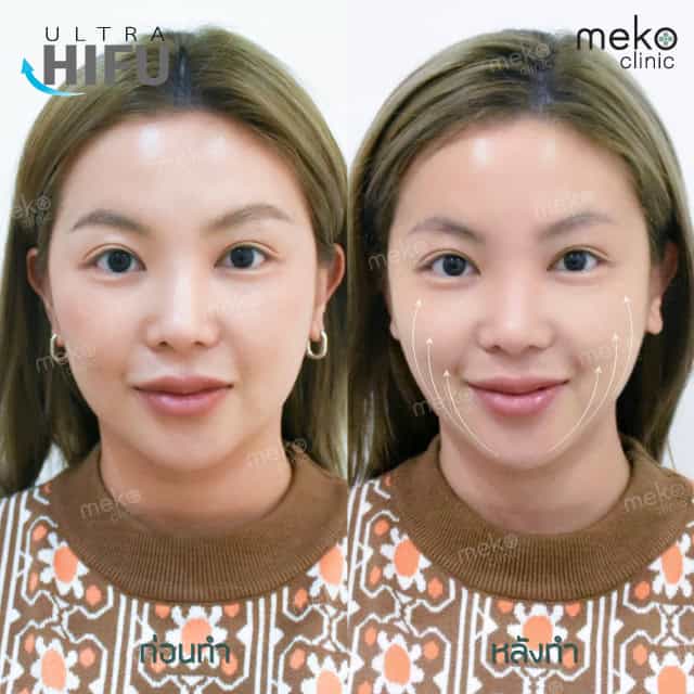 Hifu mekoclinic (เมโกะคลินิก) คุณฮารุ