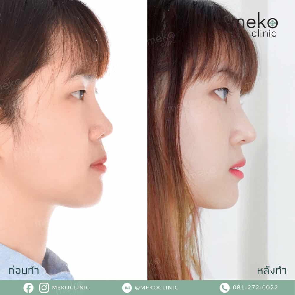 รีวิวศัลยกรรมจมูกโดยนพ. ยงเกียรติ ธนะเจริญพาณิชย์