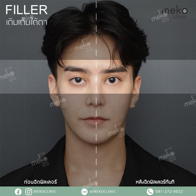 Filler ใต้ตา หมอทินน์ เมโกะคลินิก mekoclinic