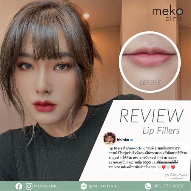 lip filler ฟิลเลอร์ปาก หมอมิ้ว เมโกะคลินิก mekoclinic