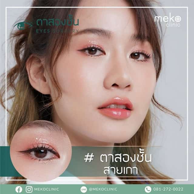 ตาสองชั้น เมโกะคลินิก mekoclinic