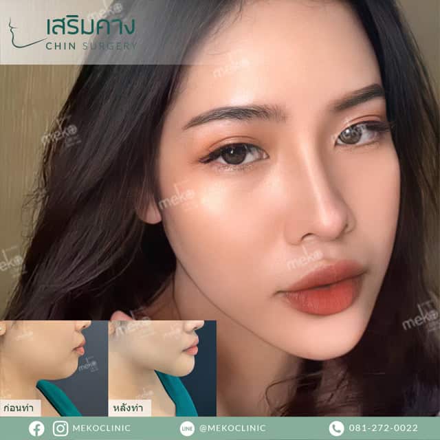 เสริมคาง หมอกานต์ เมโกะคลินิก mekoclinic