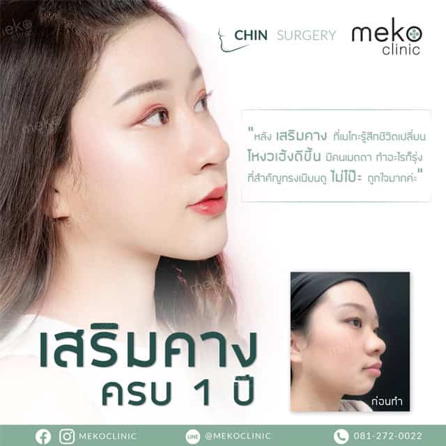 เสริมคาง หมอเนศ เมโกะคลินิก mekoclinic