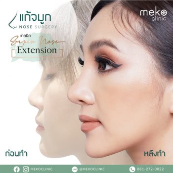 แก้จมูก หมออา เมโกะคลินิก