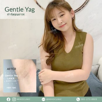 Gentle Yag กำจัดขนถาวร เมโกะคลินิก mekoclinic