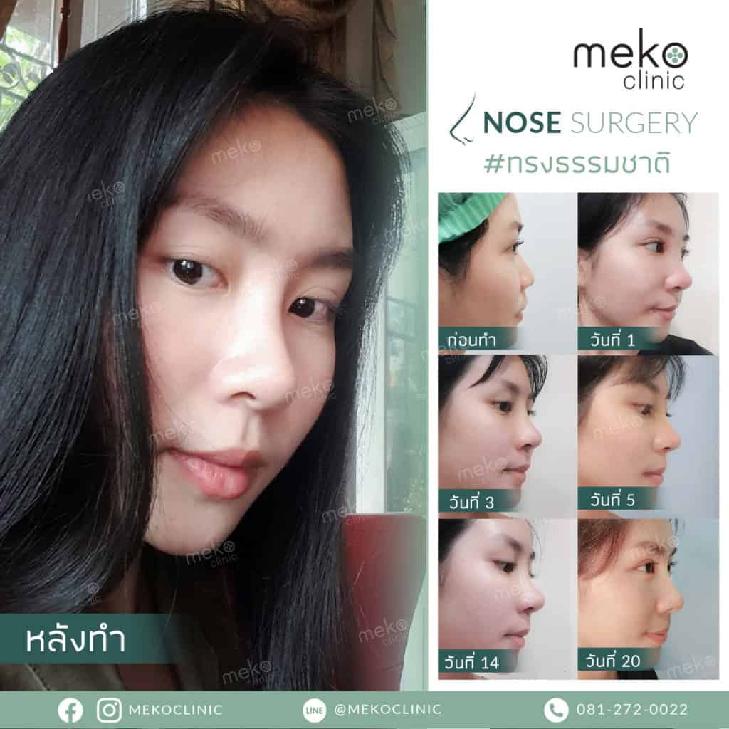 ประสบการณ์เสริมจมูก กับ คุณหมอกานต์ ที่ เมโกะ คลินิก