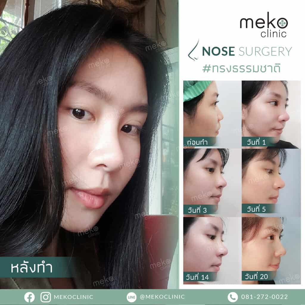 ประสบการณ์เสริมจมูก กับ คุณหมอกานต์ ที่ เมโกะ คลินิก