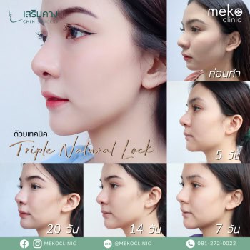 รูปรีวิวเสริมคาง-คุณแป้ง-ที่เมโกะคลินิก