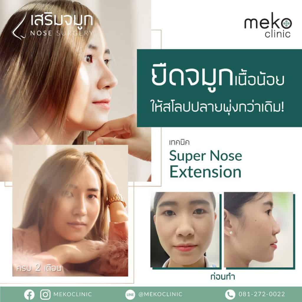 ยืดจมูกเนื้อน้อย ให้สโลปปลายพุ่งกว่าเดิม ( คุณแนน หมอชัย เมโกะ คลินิก)