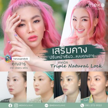 เสริมคาง เสริมโหงวเฮ้ง ปรับรูปหน้าเรียว แบบคุณฮารุ โดย หมอมนัส เมโกะ คลินิก