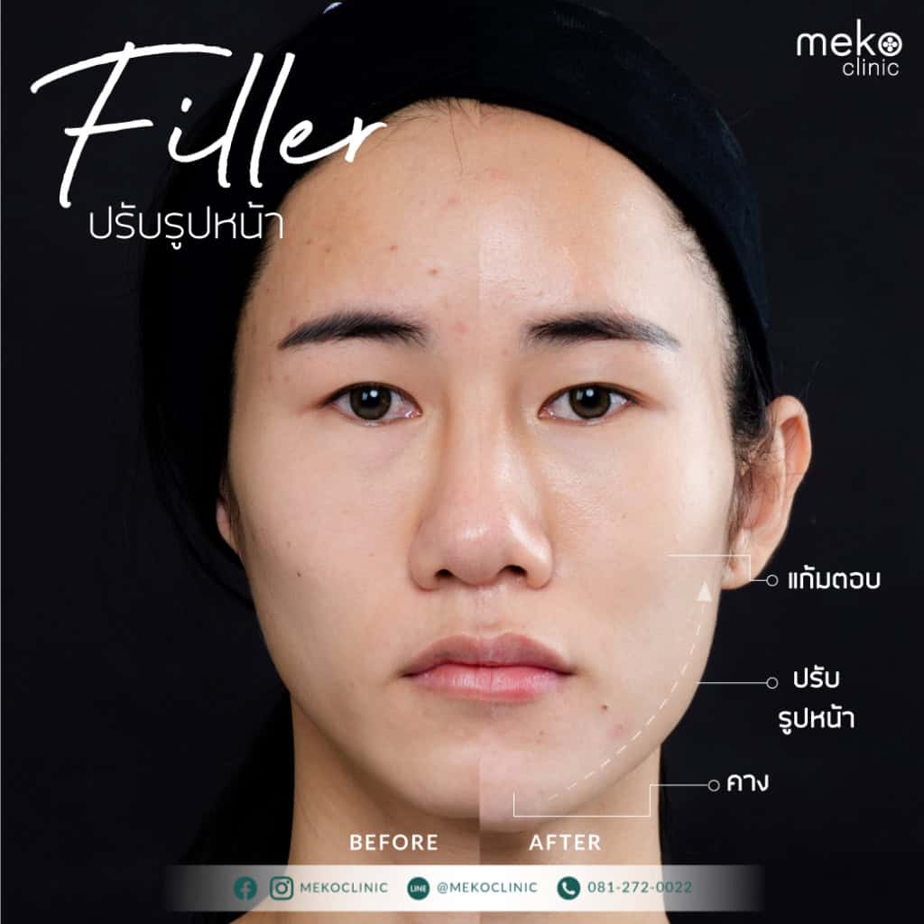 ฟิลเลอร์ หมอฝนพลอย เมโกะ คลินิก คุณฮันนี่