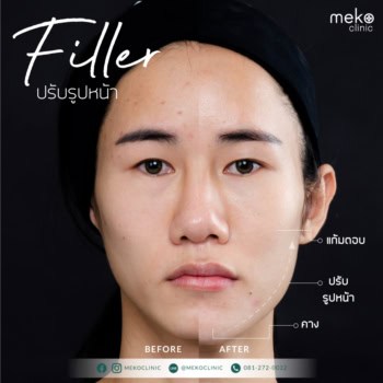 ฟิลเลอร์ หมอฝนพลอย เมโกะ คลินิก คุณฮันนี่
