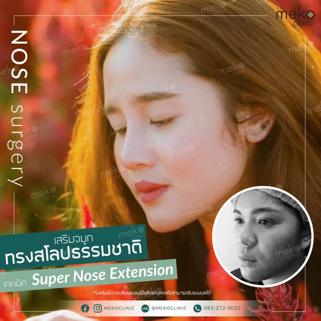 เสริมจมูก ทรงสโลปธรรมชาติ โดย หมอยง เมโกะ คลินิก (คุณจรรลินญา)