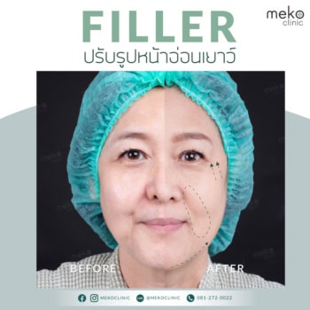 ฟิลเลอร์-เมโกะ-คลินิก-คุณปุ้ย