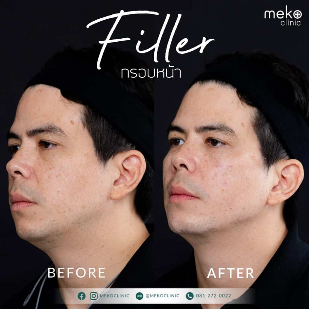 ฟิลเลอร์ เมโกะ คลินิก คุณทิม
