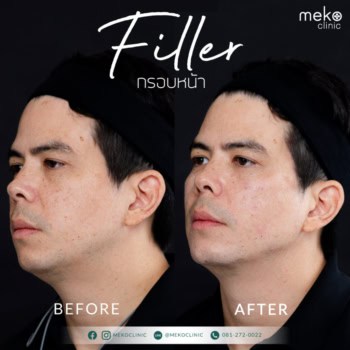 ฟิลเลอร์ เมโกะ คลินิก คุณทิม